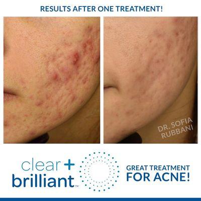 Clear and Brilliant ! Amazing results after one treatment! Come in for your treatment today!  We offer complementary consultation!