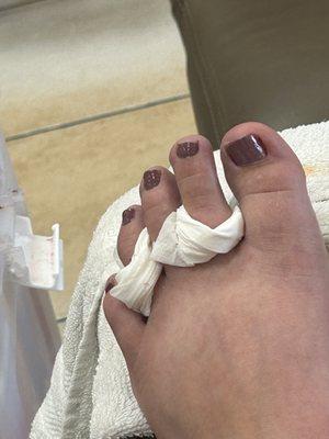 My bleeding toe and crappy towel In between   my toes.