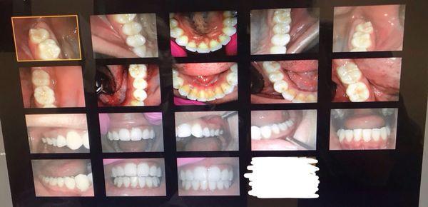 My teeth before (so bad and I blocked out the picture of my face)