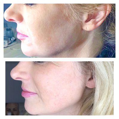 Jawline contouring with Juvederm Voluma