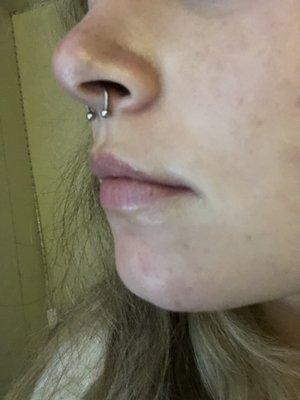 My piercing that is misplaced, too far back and low.