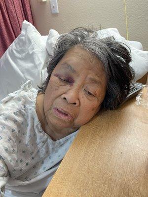 After my mom fell I took a picture of how heavily medicated she appeared.  Notice the black eye and knot above her eyebrow