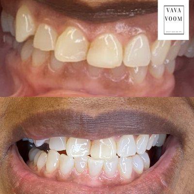 Teeth Whitening 45 min session Before and after