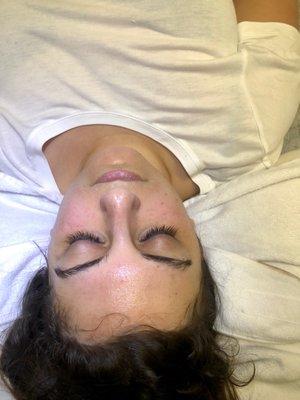 After HydroDermabrasion Facial