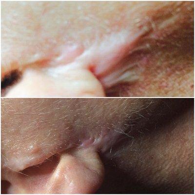 Before and after pictures of six Micro Pen/ treatments to reduce scarring