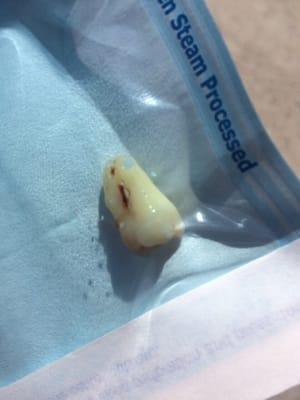 My wisdom tooth. Yes, I kept it :)