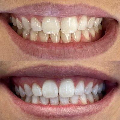 Results of Zoom whitening