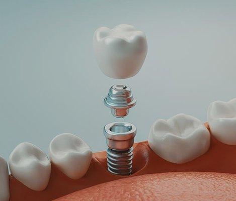 Dental Implants