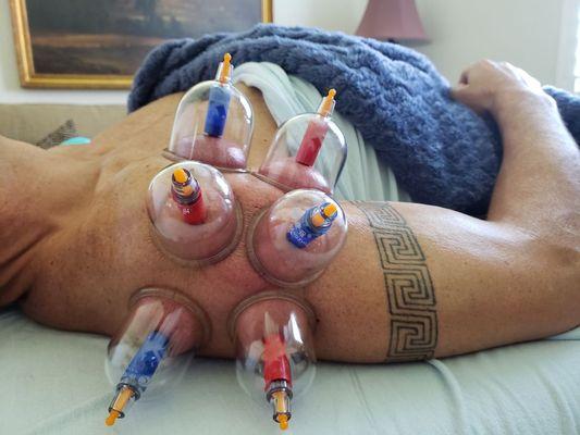 Biomagnetic cupping therapy on shoulder. Great for chronic pain, tension, tendonitis, insomnia, migraines...etc