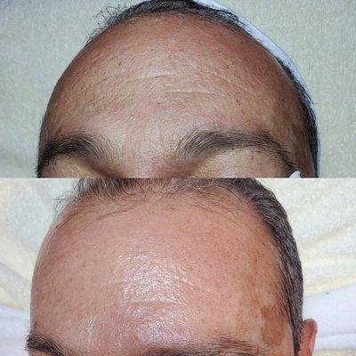 Before and after anti-aging facial