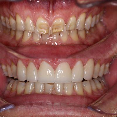 6 veneers to correct wear and discoloration