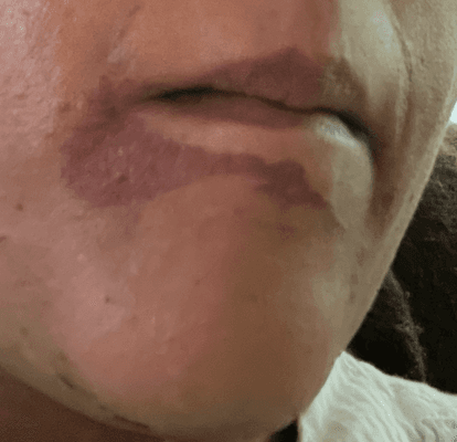 second day after waxing, on the lower lip, chin