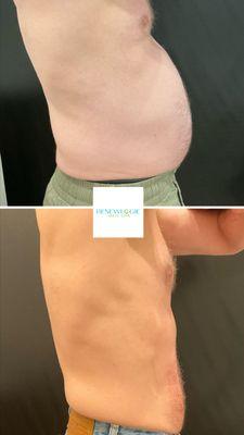 EmsculptNEO transformation at Renewlogie. Patient completed series of 10.