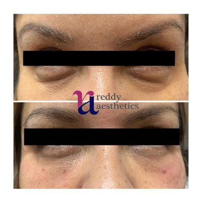 before and after 1ML syringe of Restylane Lyft for under eyes