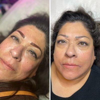 Another amazing result with our Five Day Peel