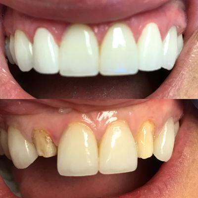 Lateral porcelain veneers