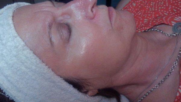 After Dermaplan Facial Picture