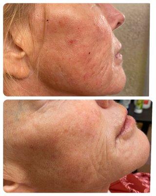 RF microneedling also lightens and brightens!