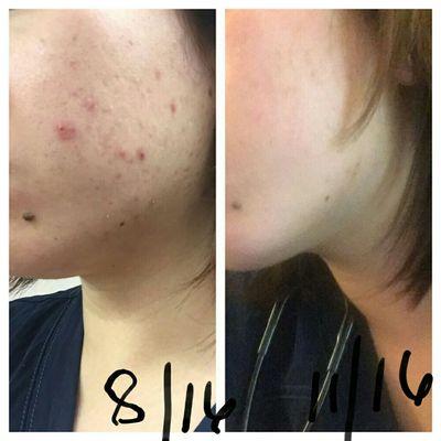 Acne Clinic Las Vegas  By Justina