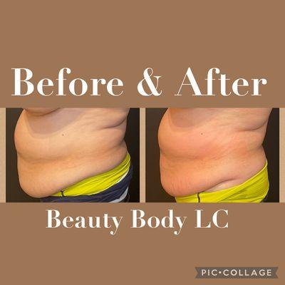 Before and after of a Lipo Cavitation session