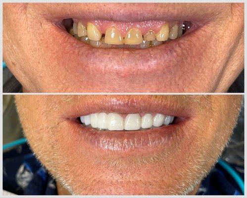 Full mouth rehabilitation with zirconia crowns to treat missing discolored teeth  and "gummy smile".