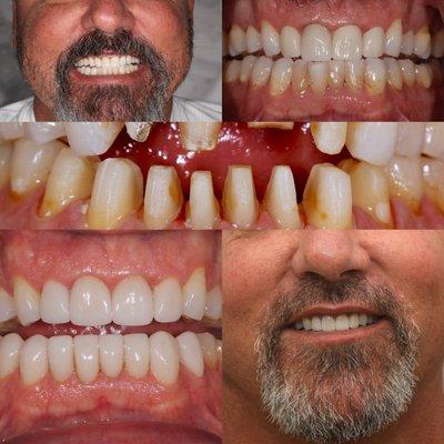 Creating better smile with porcelain veneers and crowns