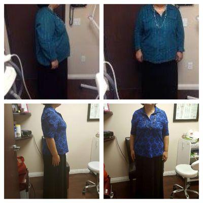 This patient lost 120 Lbs in 6 months and 20 cm off her stomach with body sculpting.  She has maintained her results for 3 years now!