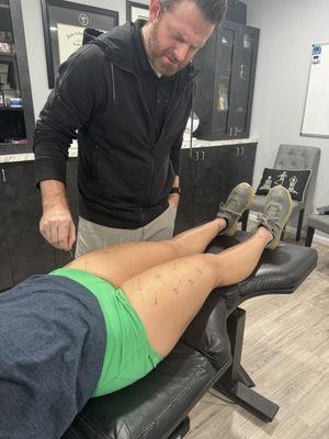 Dry Needling on the quadriceps muscles.