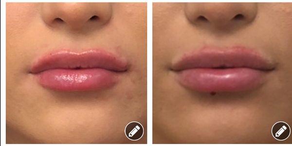 We used Restylane Defyne to give her more volume for lips.