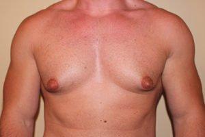 BEFORE: 30 yo male 9 months after liposuction with glandular excision