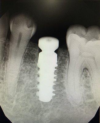 Missing a tooth? No worries! Implants are a great way to replace single or multiple teeth, and are done everyday here!