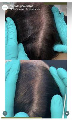 Hair restoration at Renewlogie with PRP injections and Pepfactor microneedling. Series of 3 recommended.