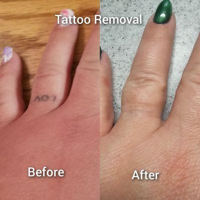 Tattoo removal before and after