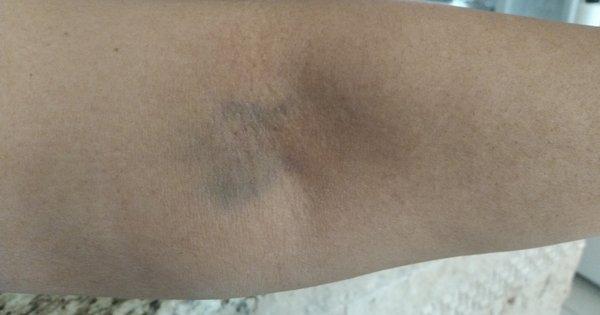 Bruised arm from her inserting and reinserting needle several times and being unsuccessful. I asked her to use my other arm, she ignored me.