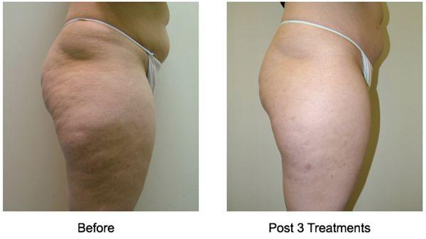 VelaShape for Cellulite!