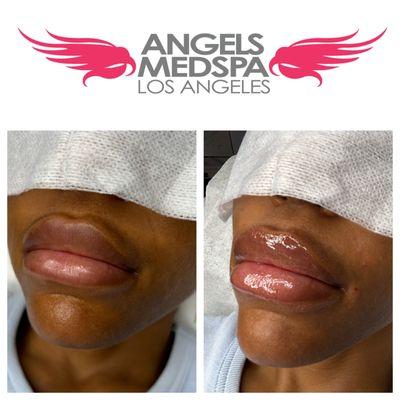 Angels Med Spa Los Angeles