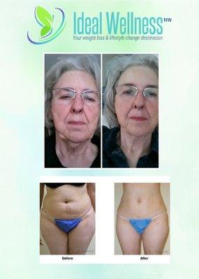 Our new Lipo Melt Results! Call today! 360-464-4434