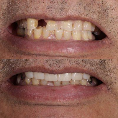 Combination of implants and veneers