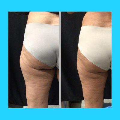 Post Coolsculpting to the outer thigh