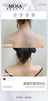 Botox relaxe shoulder