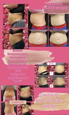 Body sculpting laser lipo wood therapy treatments