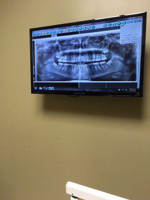 My X-ray from when I got 3 of my wisdom teeth removed.