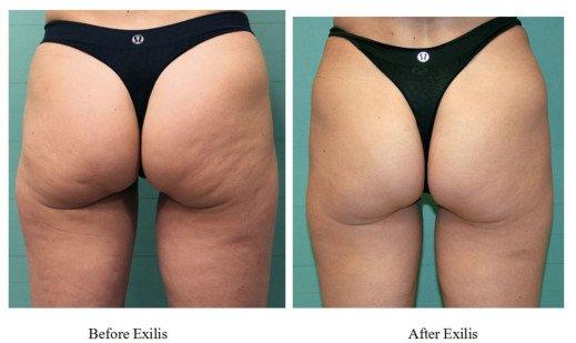 6 treatments of Exilis Elite