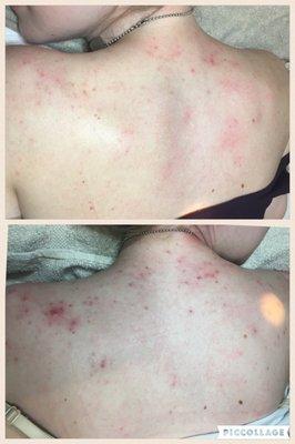 After is the top picture! Microdermabrasion and Jan Marini body wash to clear up this back!