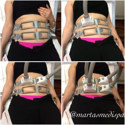 Instagram: @martasmedispa
 SculpSure Laser Body Contouring Treatment (on the abdomen) Time? 25 minutes Downtime? None! Pain? None!