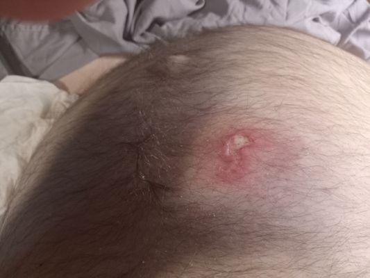 I put a plate on my chest ,it must have been hot ,it blistered, a few days later cleaned it ,puss was removed and now this