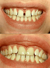 Before and after dental makeover