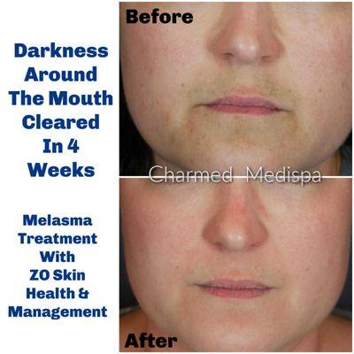 Skin care to improve darkness around the mouth.