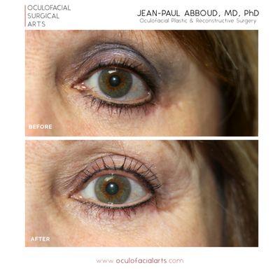 Lower Eyelid Revision Surgery and Retraction Repair via Midface Lift and Canthoplasty