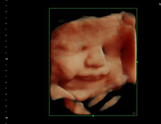 Calm, happy baby as seen in a SonoSmile 3D ultrasound image using HDlive.